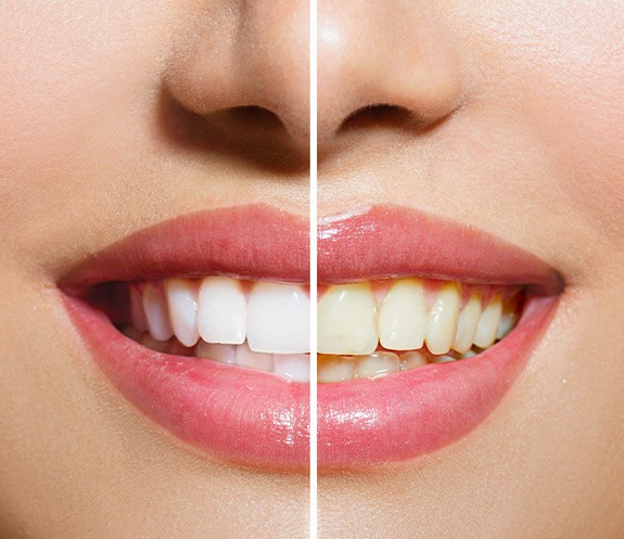 Nose-to-chin view of woman smiling with half her teeth whitened