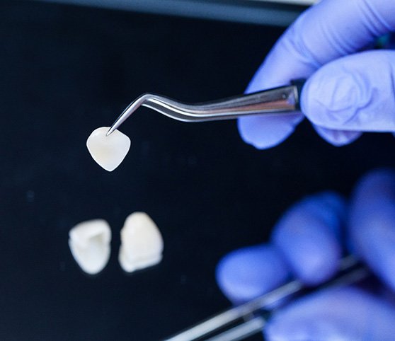 Dentist holding veneer with tweezers