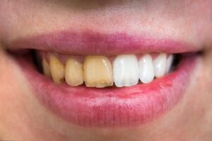 Before and after teeth whitening comparison